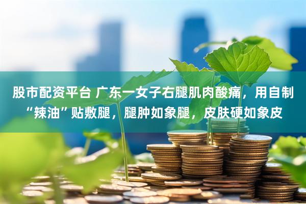 股市配资平台 广东一女子右腿肌肉酸痛，用自制“辣油”贴敷腿，腿肿如象腿，皮肤硬如象皮
